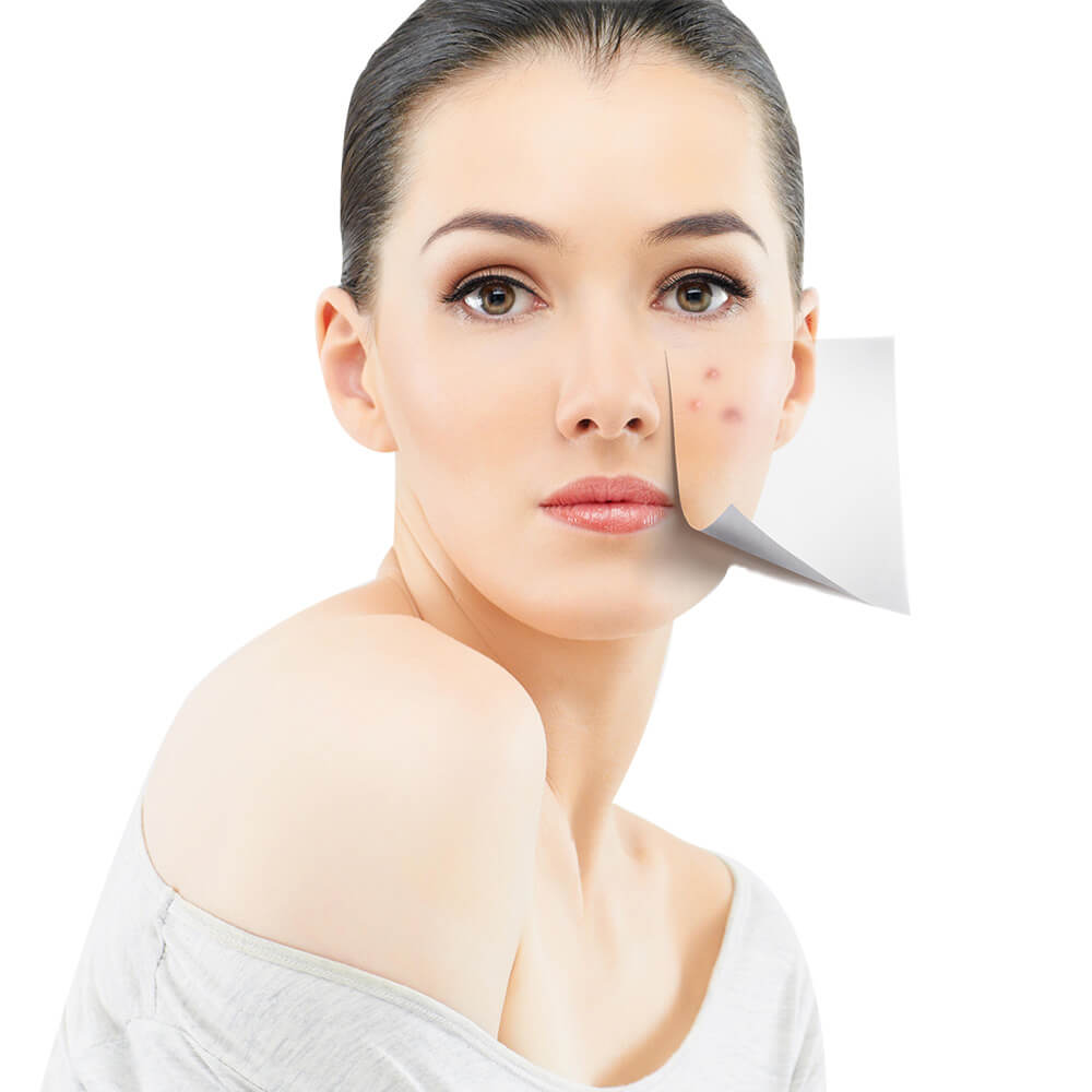 Acne and Scars Treatment